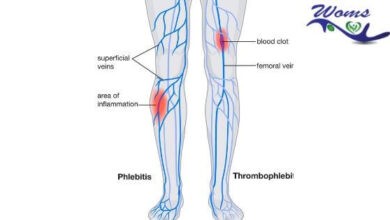 phlebitis and thrombophlebitis